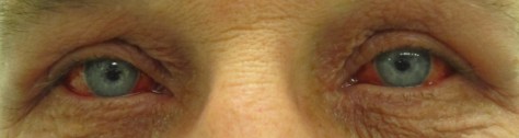 Viral Conjunctivitis