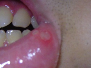 Aphthous ulcer 2 on lip
