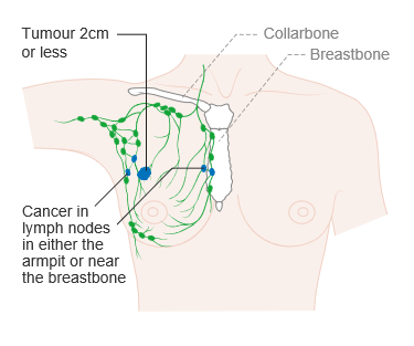 A Schematic Illustration Of Breast And Lymph Node Tumours