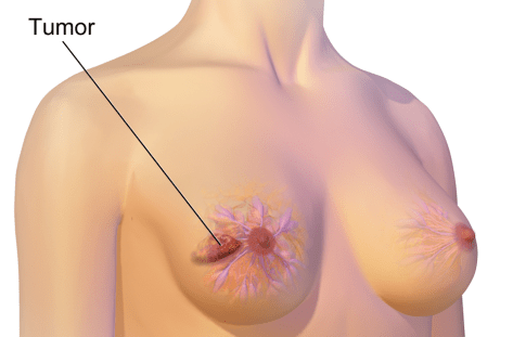 Breast Tumour From Chris Dugglebys article about Blind Carers Using Tactile Sensitivity to Detect Breast Cancer