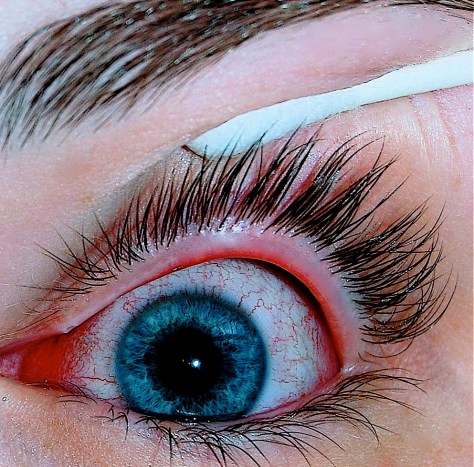 Eye with viral conjunctivitis