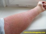 3 Allergic Contact Dermatitis From Washing Additives - Left Arm