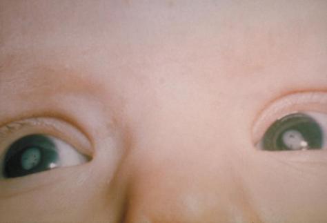 Baby with cataracts in both eyes