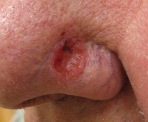 Basal cell carcinoma 1 See Skin Cancer And Cataracts From Vehicle Side Windows at ChrisDugglebydotcom