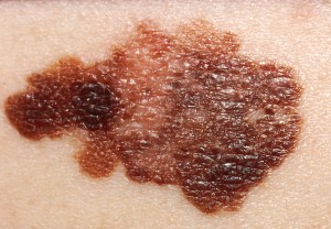 Skin Cancer Melanoma