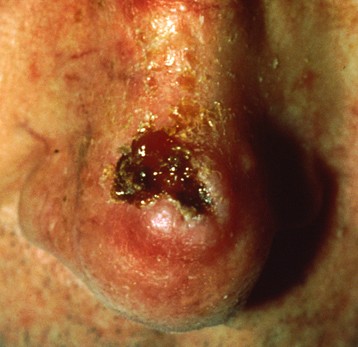 Squamous Cell Carcinoma