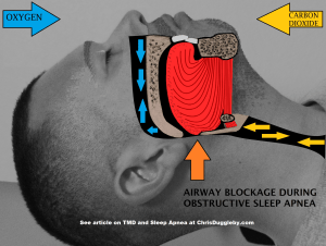 With Sleep Apnea the airways become blocked and prevent breathing