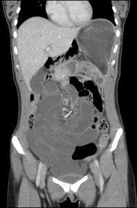 Orthodontic Abdominal Piercing Courtesy Dr Talia Shepherd see Article at ChrisDugglebydotcom
